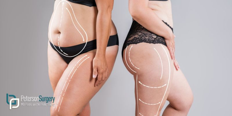 The Liposuction Recovery Process: Tips for a Smooth and Comfortable Healing